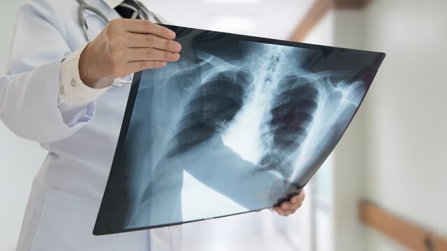 متخصص بیماری‌های داخلی: ترمیم بافت ریه یک ماه و نیم تا ۳ ماه زمان می‌برد