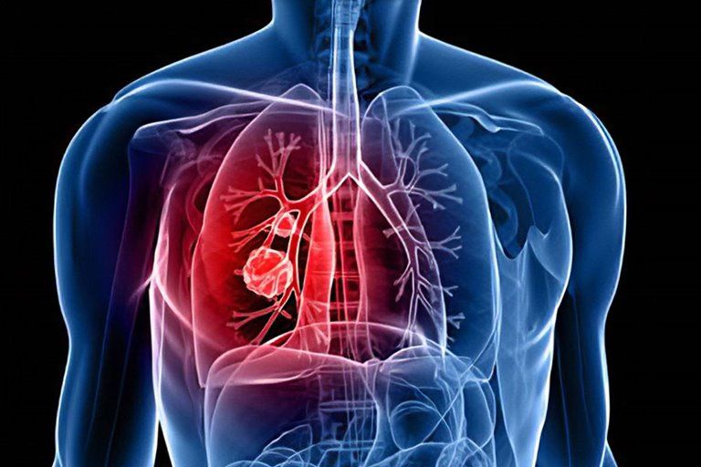 سرطان ریه غیرسیگاری‌ها ازنظر ژنتیکی از تومورهای افراد سیگاری متفاوت است